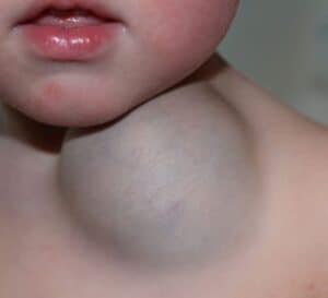 vascular malformation