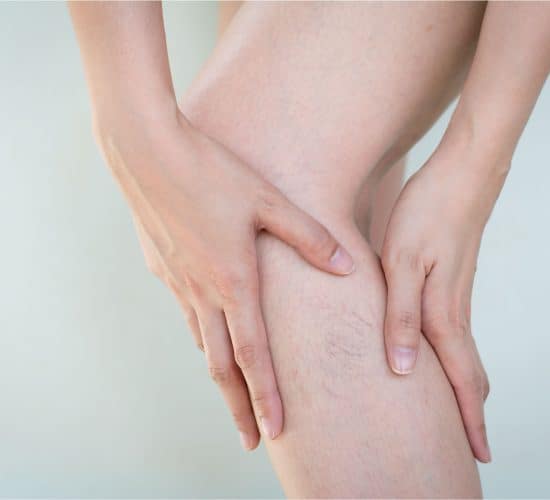 Varicose & Spider Veins