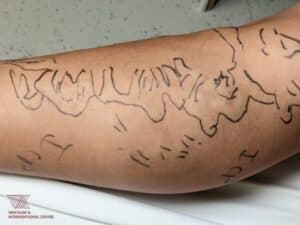 varicose veins procedure singapore