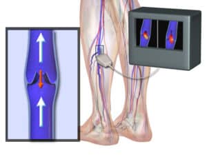 varicose veins surgery