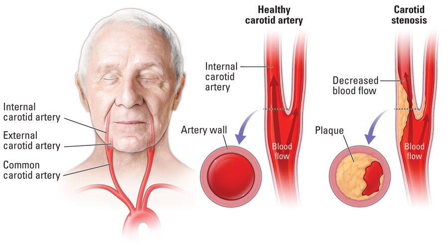 Carotid Arterial Disease
