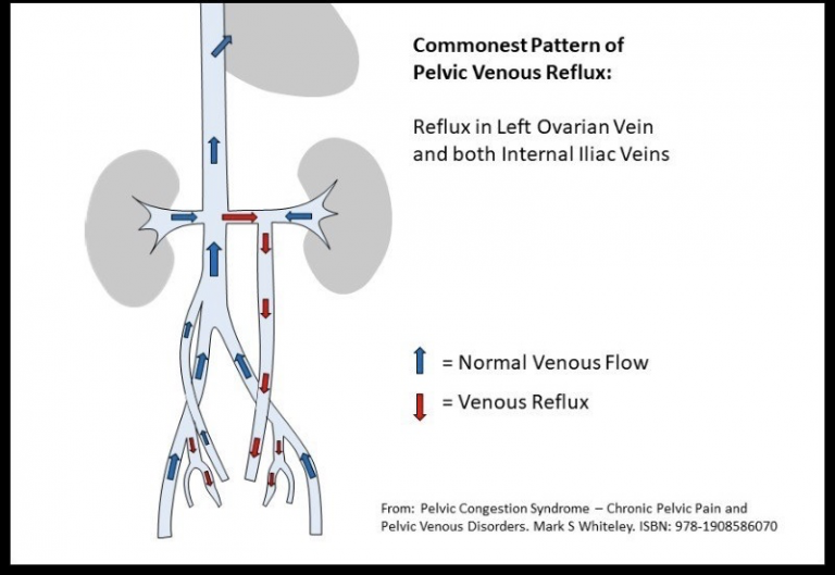 Pelvic Congestion Syndrome  Vascular & Interventional Centre
