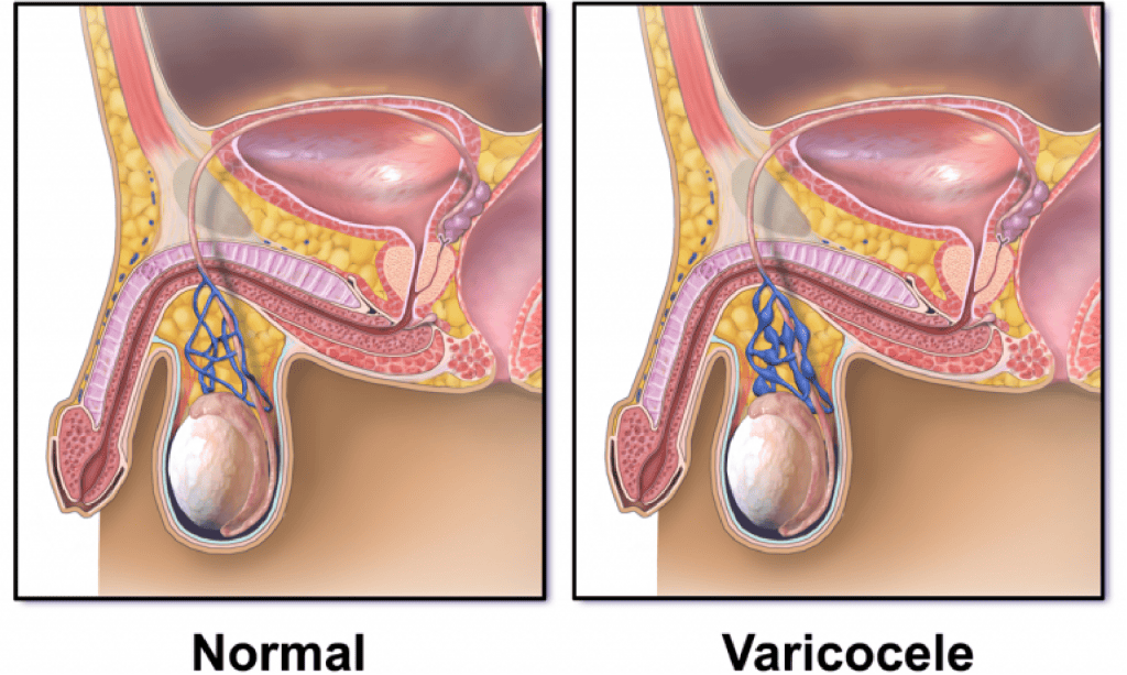  varicocele treatment singapore