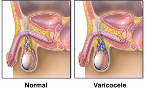 varicocele