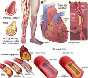 peripheral arterial disease