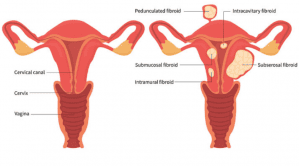 Uterine Fibroids