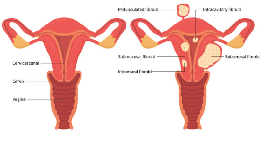 All you need to know about Uterine Fibroids