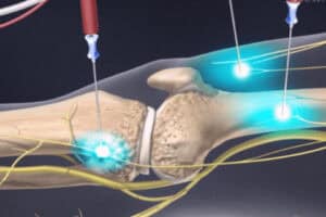 Radiofrequency-ablation