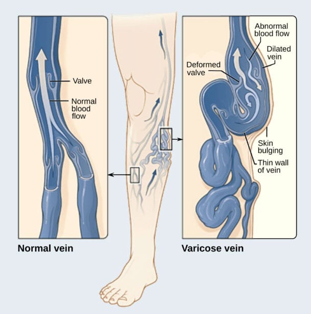 Varicose vein treatment Singapore