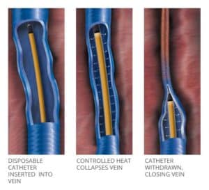varicose veins treatment singapore cost