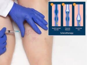 varicose veins treatment singapore cost