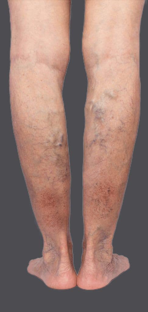 How to Prevent Recurring Varicose Veins