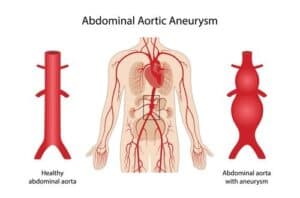 abdominal aortic aneurysm treatment singgapore