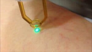 varicose veins treatment singapore cost
