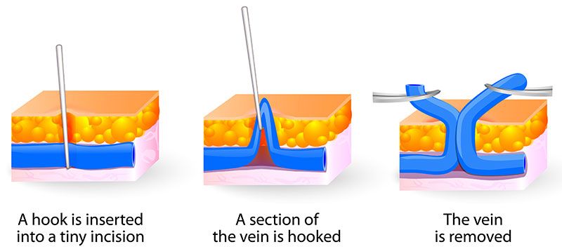 varicose veins treatment singapore cost
