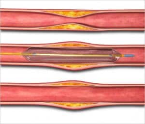 peripheral artery disease treatment