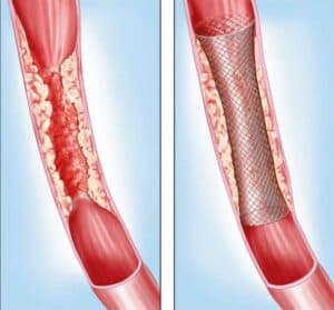 peripheral artery disease