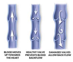 painful veins in legs singapore