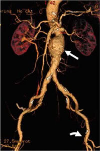 abdominal aortic aneurysm treatment singgapore