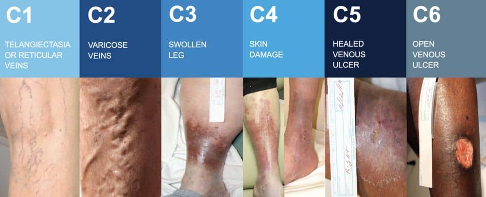 Vein Clinic Singapore  Chronic Venous Insufficiency