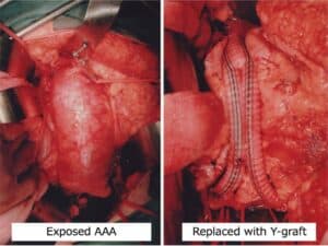 abdominal aortic aneurysm singapore