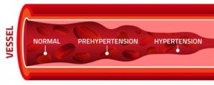 peripheral arterry disease singapore