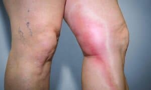 painful veins in legs singapore