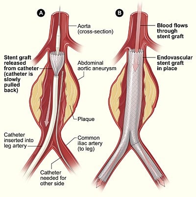 abdominal aortic aneurysm treatment singgapore
