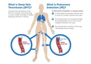 painful veins in legs singapore