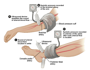 peripheral artery disease treatment