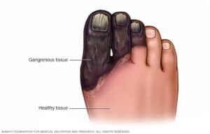 peripheral artery disease