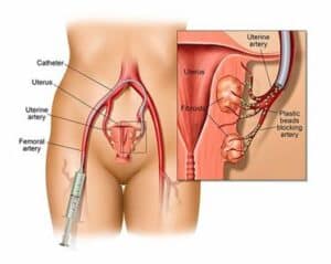 fibroids singapore