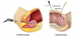 fibroids treatment singapore
