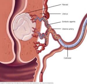fibroids singapore