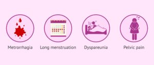 fibroids treatment singapore