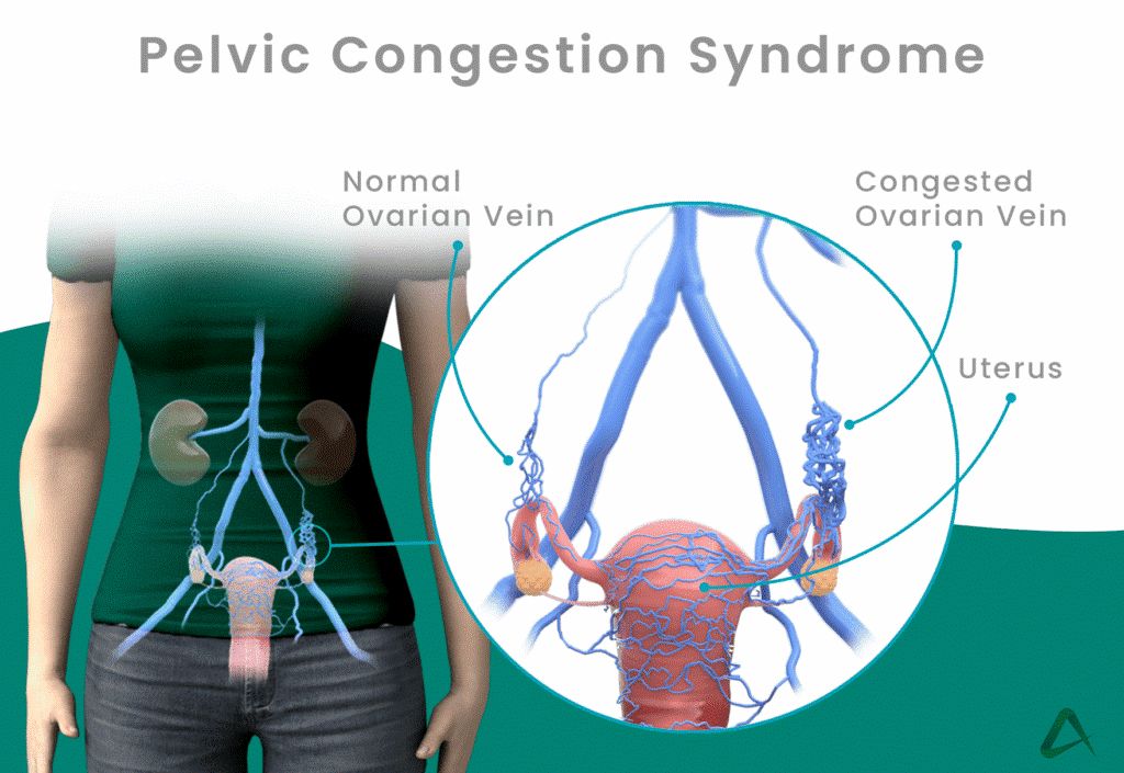 Tackling Pelvic Congestion Syndrome: A Comprehensive Guide for Singaporeans