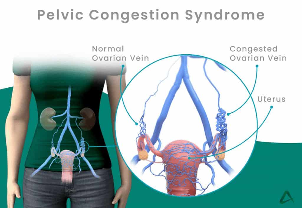 Tackling Pelvic Congestion Syndrome: A Comprehensive Guide for