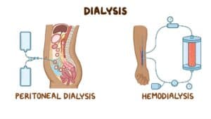 dialysis procedure singapore
