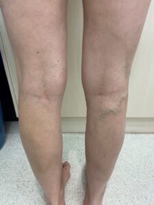 congested pelvic