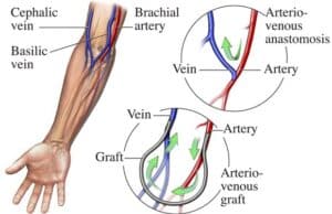 types of dialysis access singapore