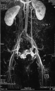 pelvic congestion syndrome