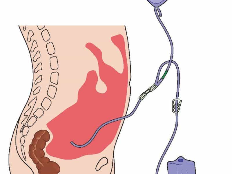 dialysis procedure singapore
