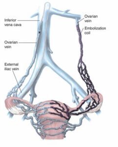 pelvic congestion syndrome