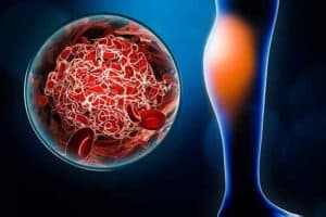 deep vein thrombosis treatment singapore