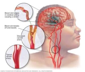 carotid artery disease treatment