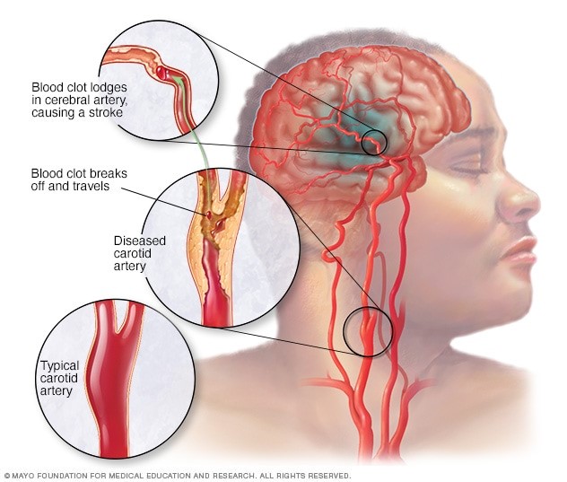 Cerebellar Artery - an overview