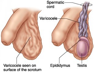 A Guide to Varicocele Treatment in Singapore