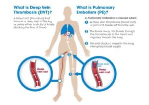 dvt specialist singapore