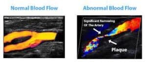 carotid artery disease treatment