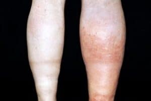 dvt treatment singapore